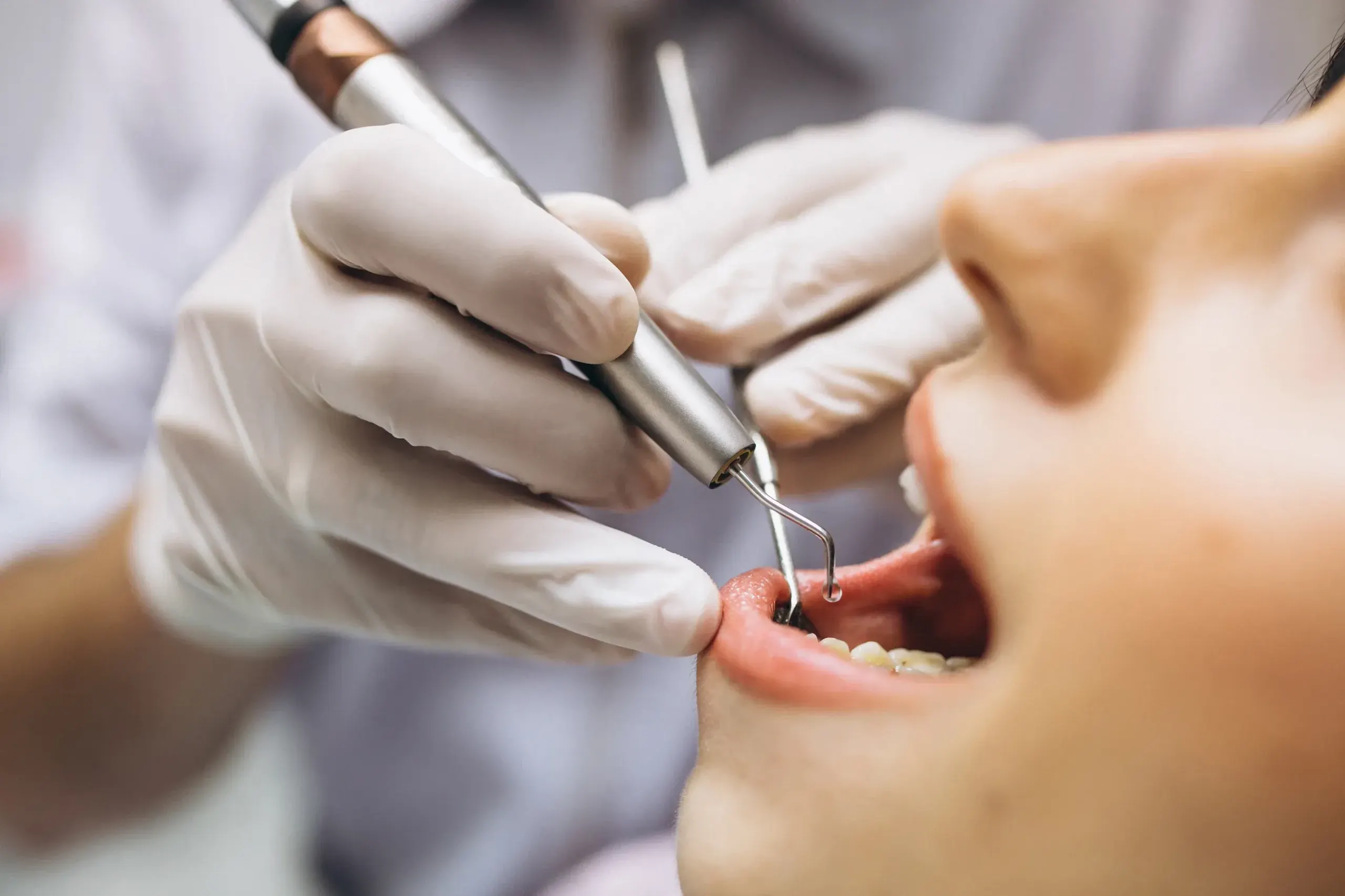 Root canal treatment at Dental World in Longwood Florida