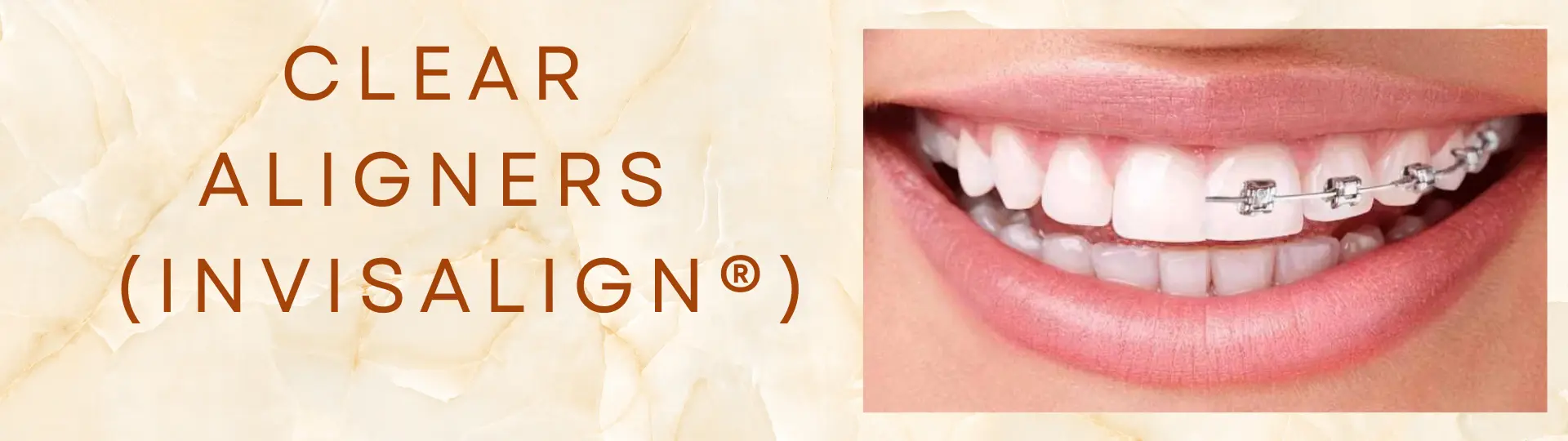 clear-aligners