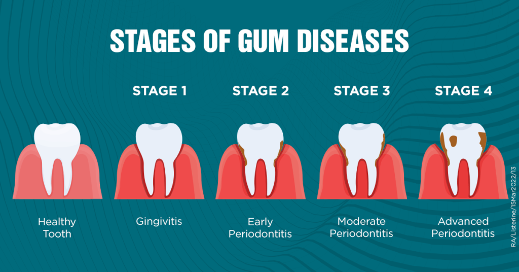 gum_disease