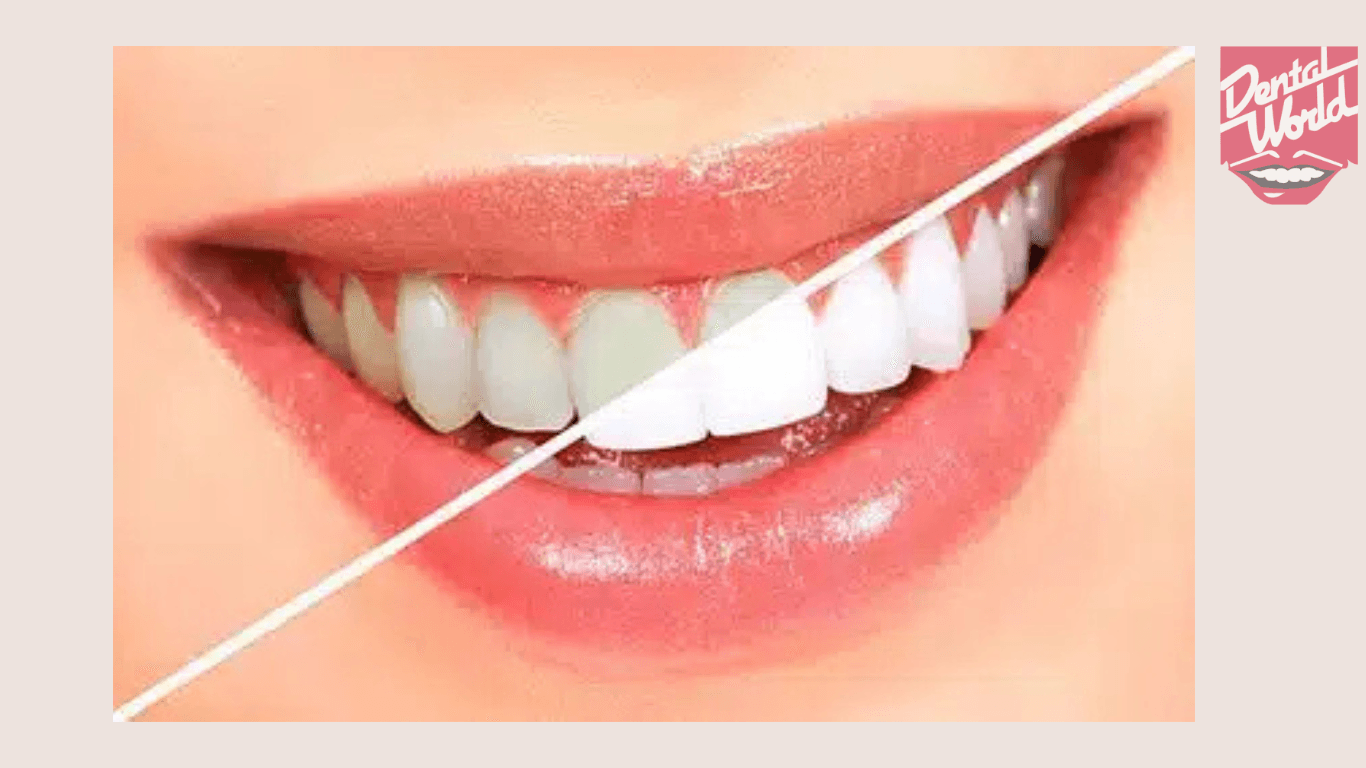 white_teethning_one_img