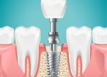 Dental-implants