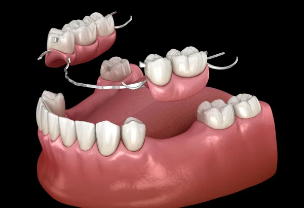 denture-&-snap-on-dentures