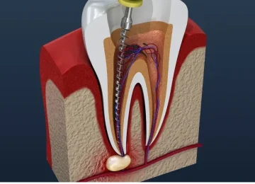 root-canal-treatment