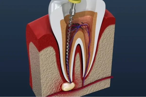 root-canal-treatment-service-